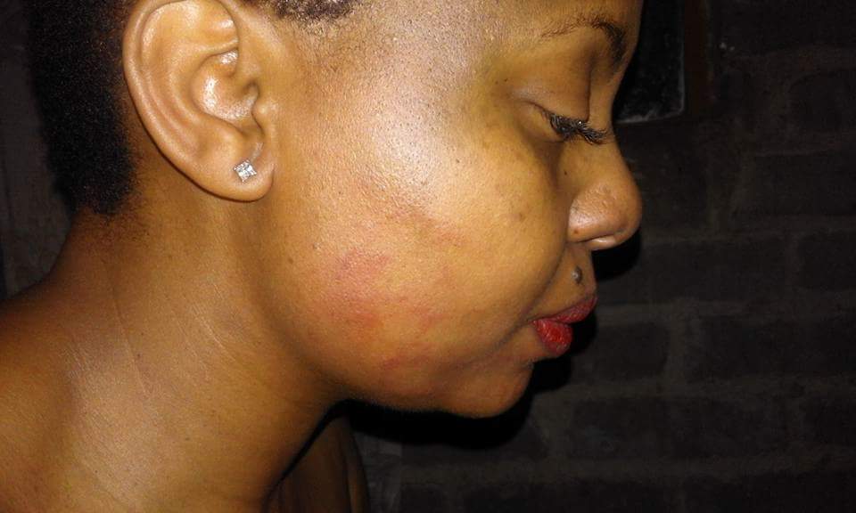 Severely Battered Woman Yolo Pityana Shows Brutalized Body