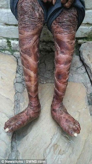 Indian Girl Who Sheds Her Skin Every Six Weeks