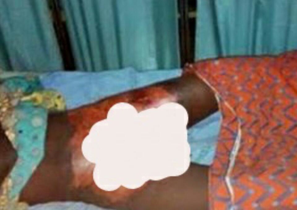 17-Year-Old Boy's Manhood Has Been Burnt By A Couple For Allegedly Raping Their 4-Year-Old Daughter In Sokoto