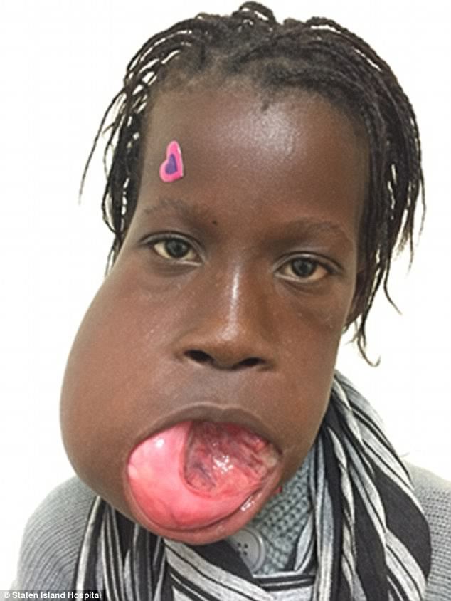 All Smiles: Janet Sylva The 12-Year-Old Gambian Girl That 6lb Tumor Was Removed From Her Mouth