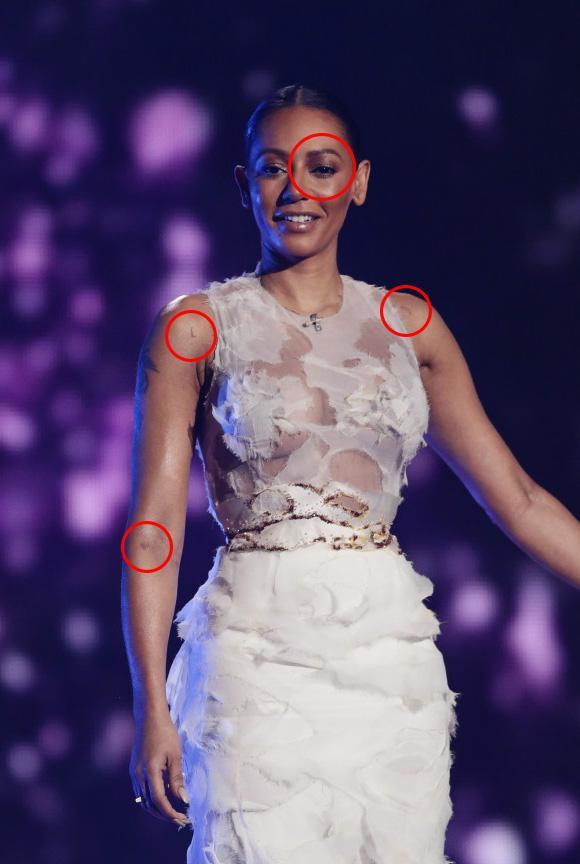 Mel B pictured with bruises during the X Factor in 2014