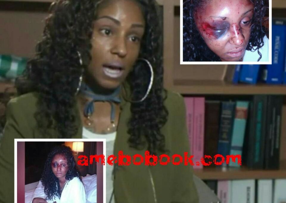 Instagram Model India Ali Who Was Beaten Up So Badly By Her IG Date James Baker That Her Brain Twisted Inside Her Skull
