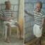 Ghost Man Suffering From The Rare Condition Ichthyosis