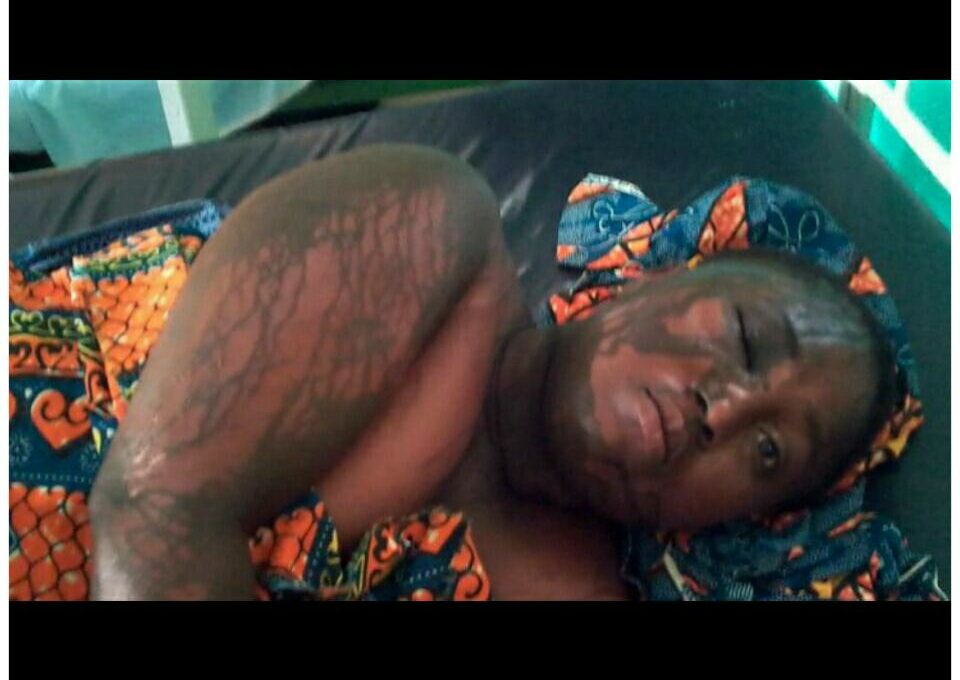 Jealous Lover Who Traced His Ex-Girlfriend To Her Home And Poured Acid On Her After Seeing Her With Another Man At Wassa Amenfi East of Ghana