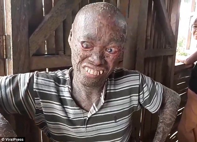 Ghost Man Suffering From The Rare Condition Ichthyosis 1