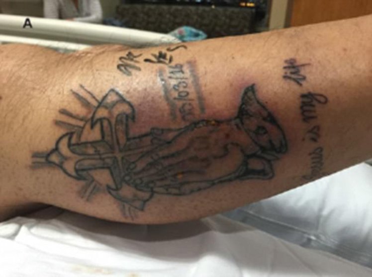 Man Who Got New Tattoo Died From Septic Shock After He Ignored Advice To Wait For Two Weeks Before Swimming 1