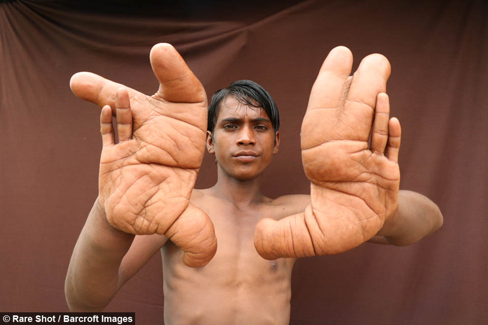 Indian Boy With Giant 12 Inches Long Hands (4)