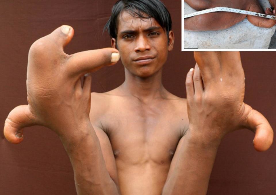 Indian Boy With Giant 12 Inches Long Hands