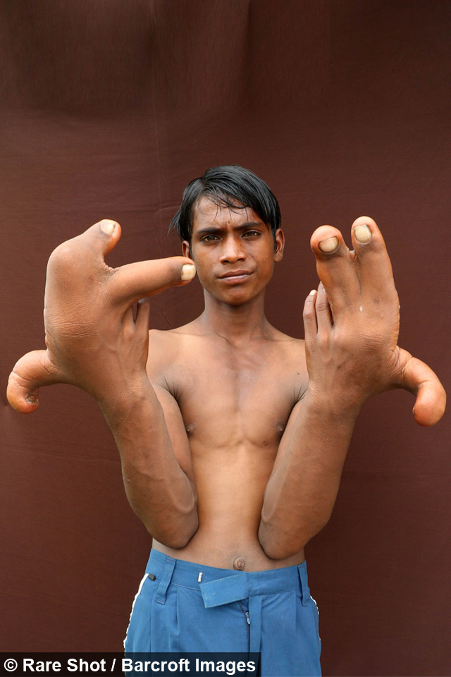 Indian Boy With Giant 12 Inches Long Hands (1)