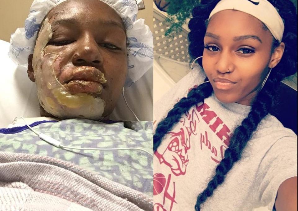 Young Burn Survivor Ashia May Cries Out After Being Hospitalized