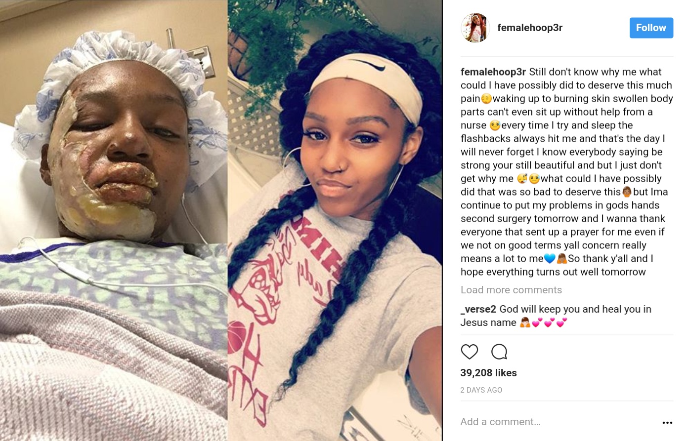 Young Burn Survivor Ashia May Cries Out After Being Hospitalized (1)