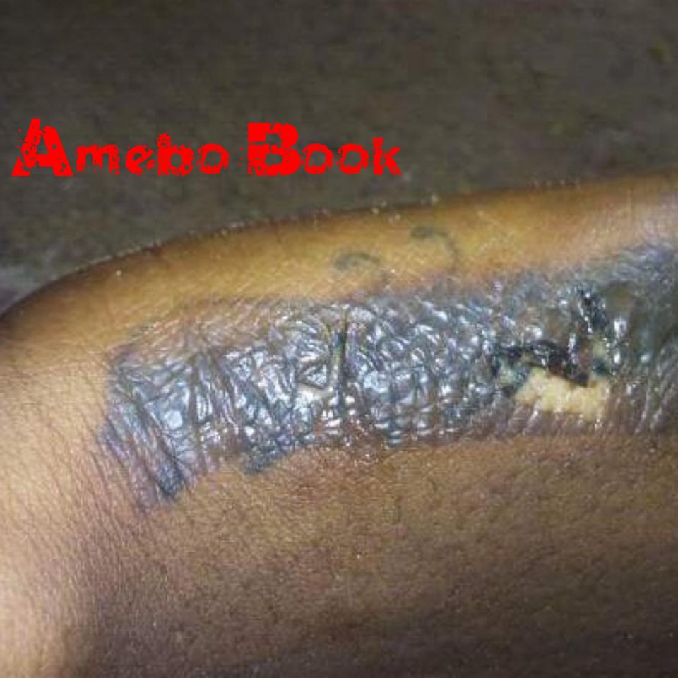 Nigerian Pastor Uses Hot Electric Iron On Her Hand To Remove Tattoo