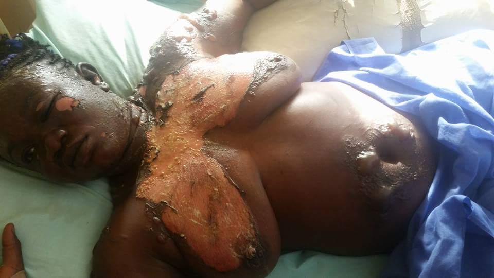 Man Poured Hot Boiling Oil On His Wife In Nasarawa State (2)