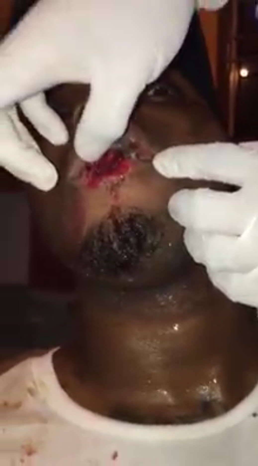 Nigerian Man Who Was Defending His Girlfriend From An Abuser Got His Lips Bitten (4)