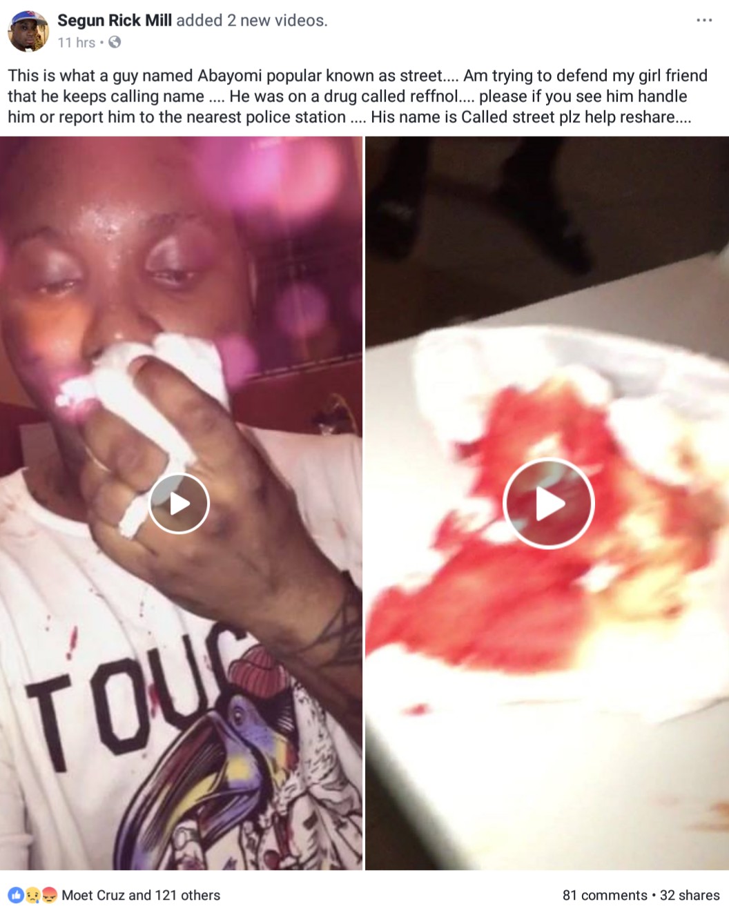 Nigerian Man Who Was Defending His Girlfriend From An Abuser Got His Lips Bitten (3)