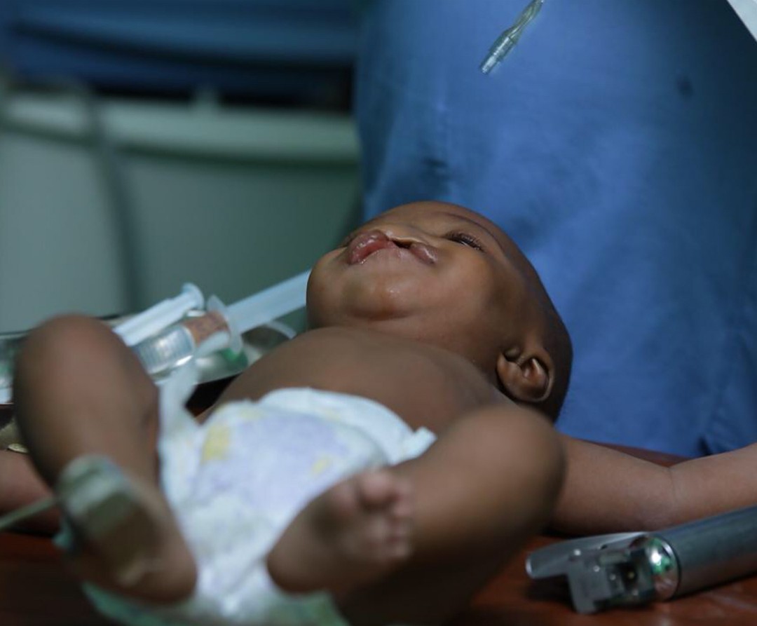 Stephanie Agbasi And Ruth Quashie Witness Surgery Carried Out On A Cleft Baby (6)