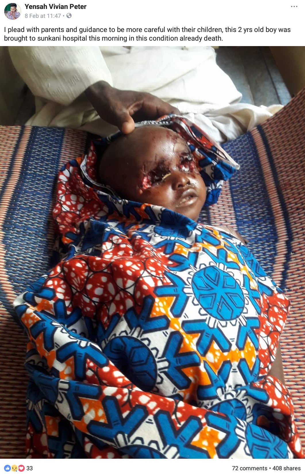 2-Year-Old Boy Whose Eyes Were Plucked Out By Ritualists In Jalingo (2)