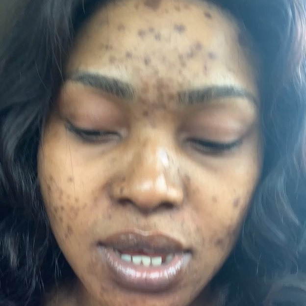 Halima Abubakar Face Completely Covered With Black Spots (2)